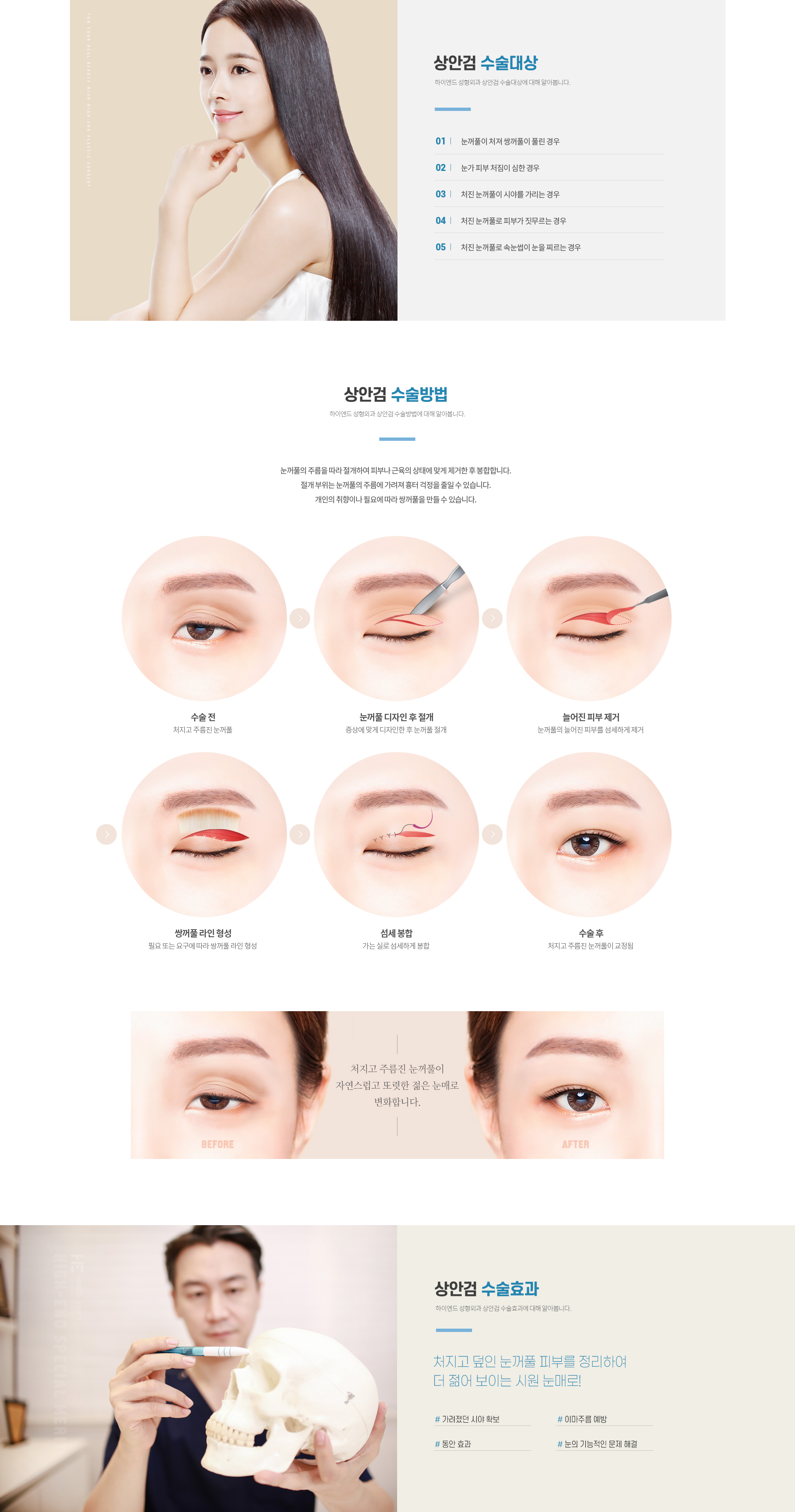하이엔드 중년 눈성형 상안검