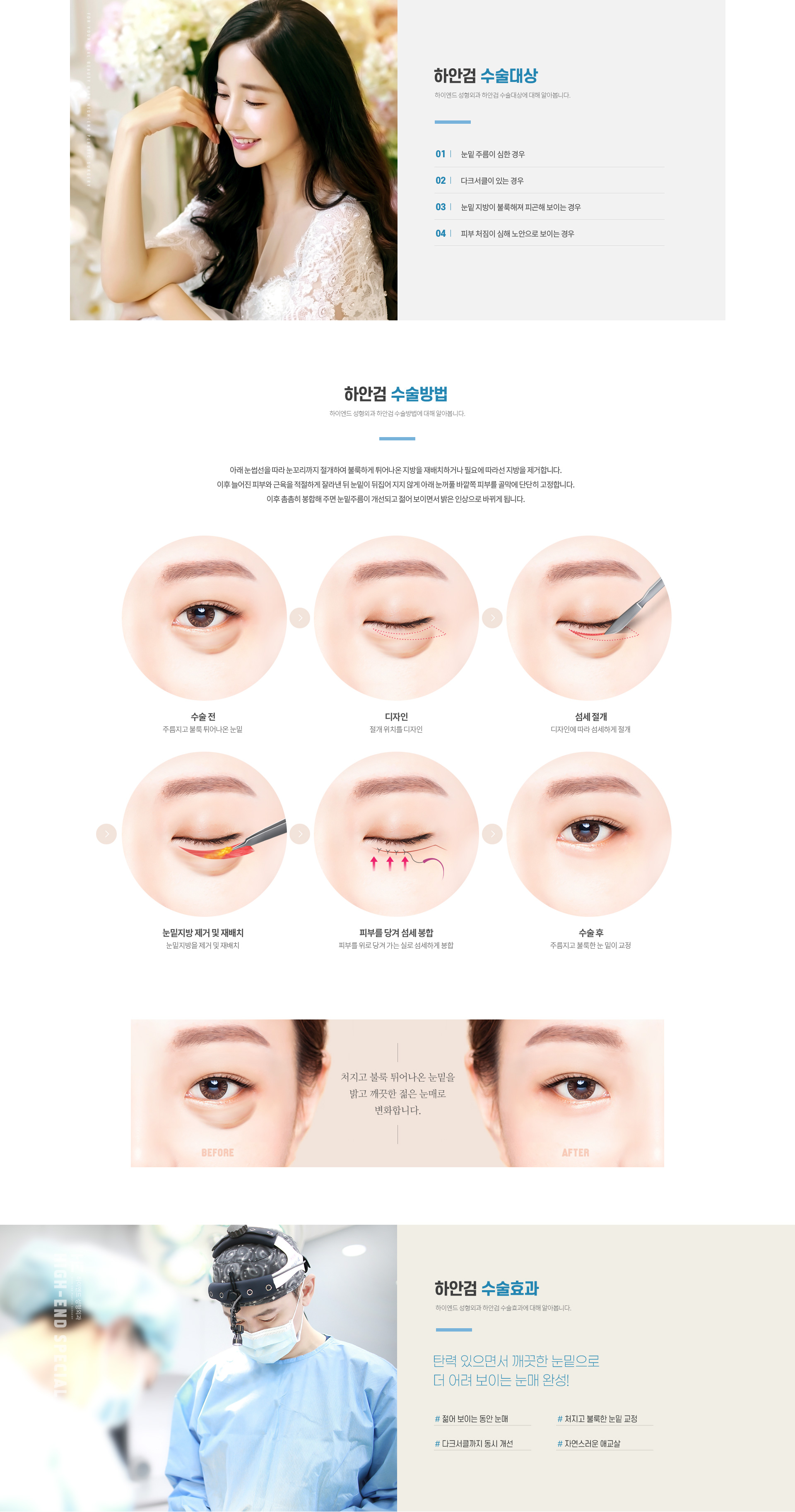 하이엔드 중년 눈성형 하안검