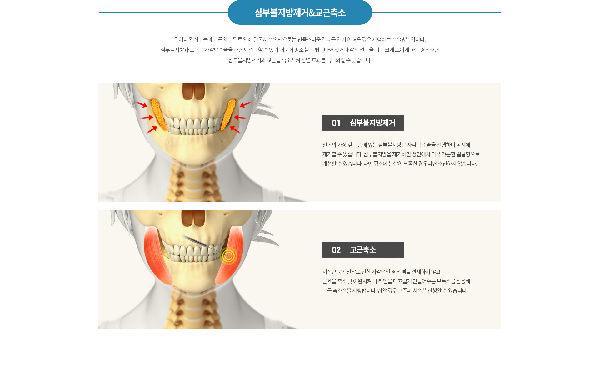 하이엔드 안면윤곽 4종 수술방법