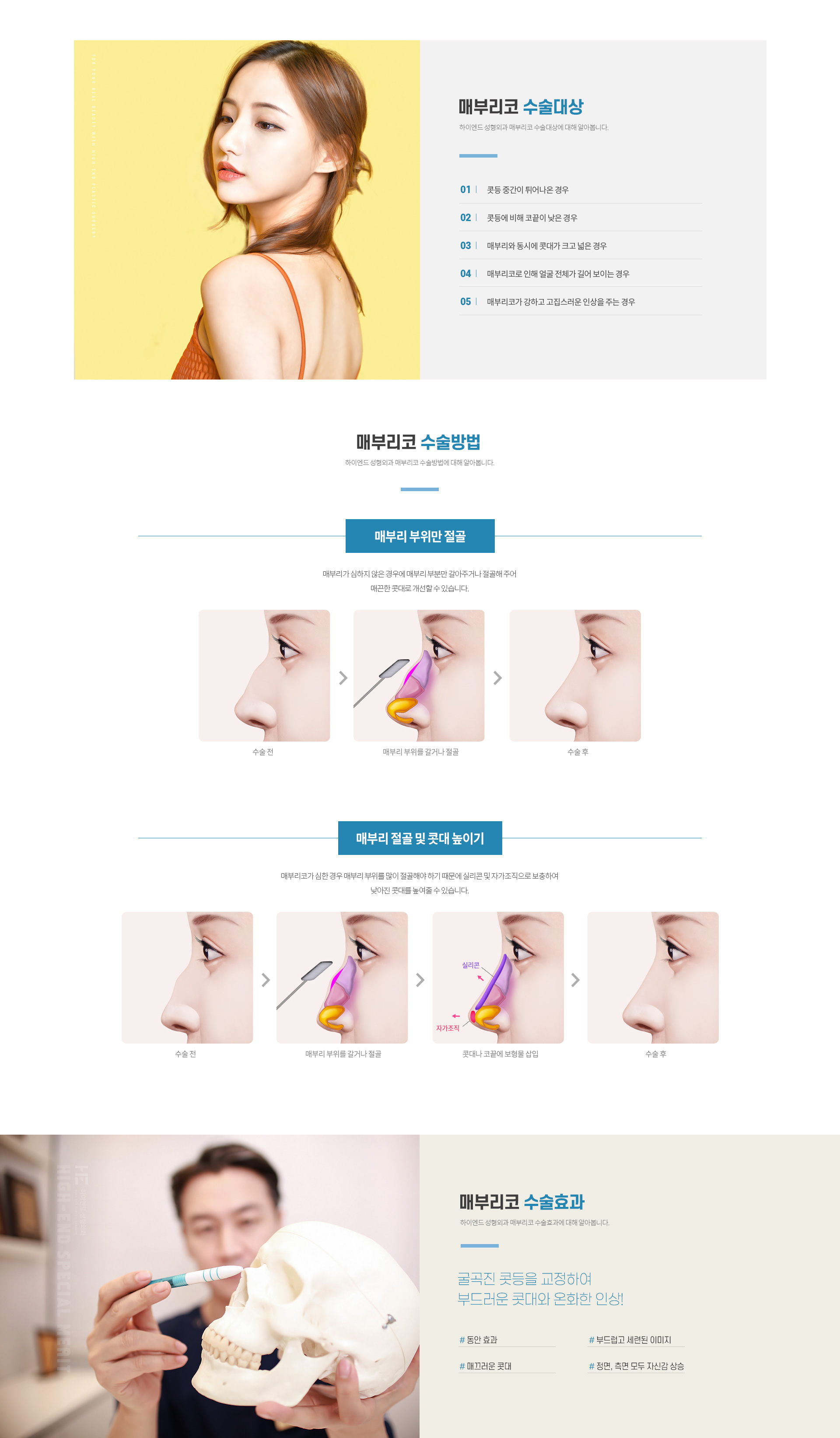 하이엔드 유형별 코성형 매부리코